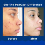 PanOxyl - Acne Creamy Wash 4% Benzoyl Peroxide Daily Control - 170g - Image 3