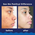 PanOxyl - Acne Foaming Wash Benzoyl Peroxide 10% Maximum Strength - 156g - Image 5