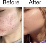 the inkey list beta hydroxy acid 30ml | the inkey list beta hydroxy acid bha serum