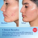 Differin - Resurfacing Scar Gel Treatment - 30ml - Image 5