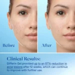 Differin - Adapalene Gel 0.1% Acne Treatment - 15g - Image 3
