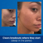 Differin - Adapalene Gel 0.1% Acne Treatment - 15g - Image 4